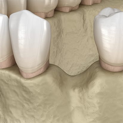 Bone grafting procedure - 1