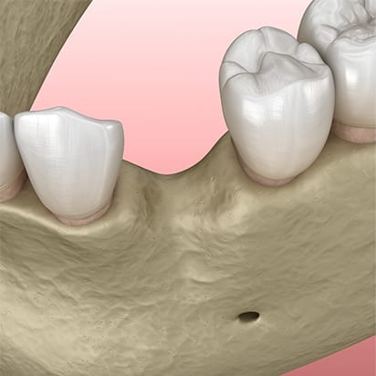 Bone grafting procedure - 2