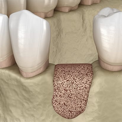 Bone grafting procedure - 3