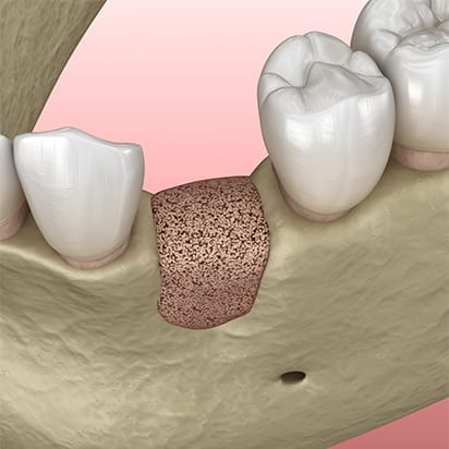 Bone grafting procedure - 4