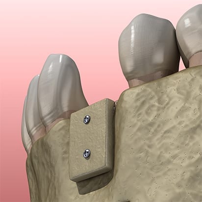 Bone grafting procedure - 5