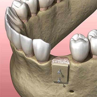 Bone grafting procedure - 6