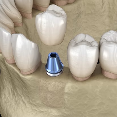 Bone grafting procedure - 7