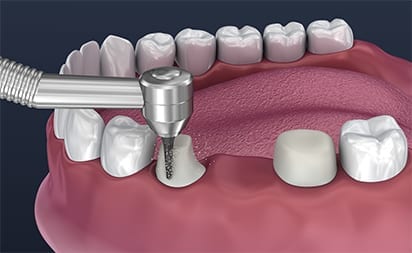 Dental Bridge Procedure pt 1