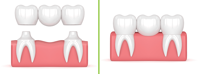 Dental Bridge