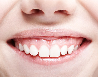 Gummy Smile