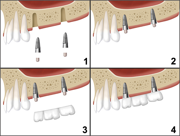 Implant-supported bridge procedure