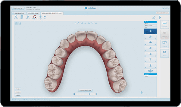Invisalign-technology