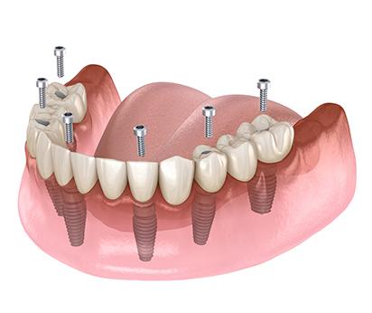 all-on-6 implants