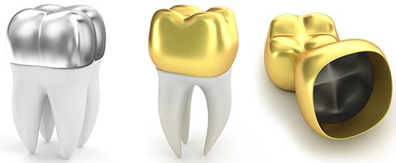 Dental Crowns: Everything you need to know : VC Dental Dental Crowns: Everything you need to know : VC Dental