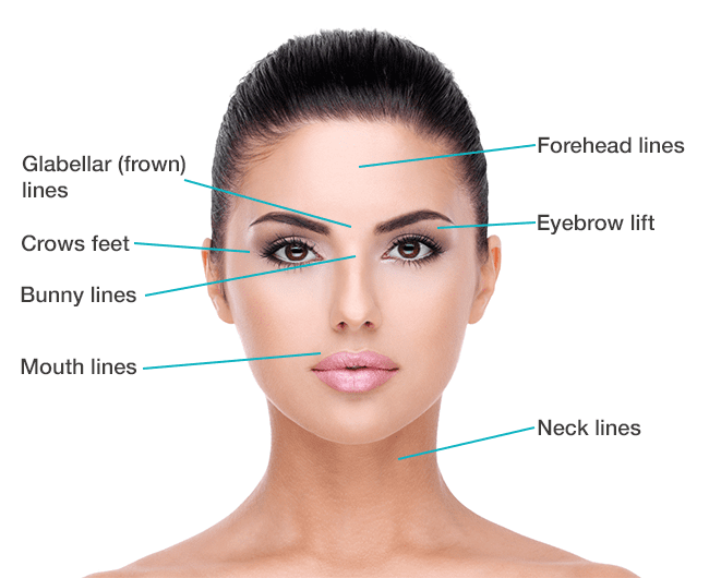 Anti - Wrinkle injection areas