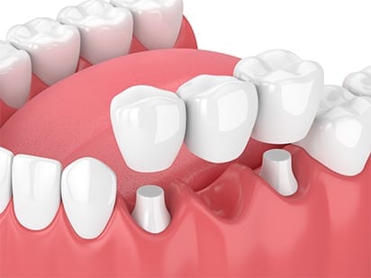 Dental bridge supported by natural teeth