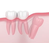Wisdom Teeth Removal in Gosford, 7 Days: VC Dental