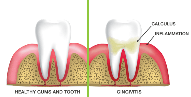 Gingivitis