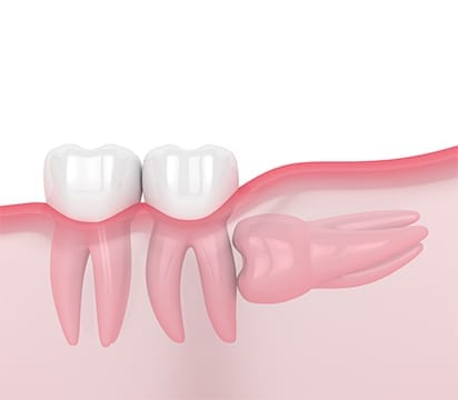 Horizontal impacted wisdom tooth