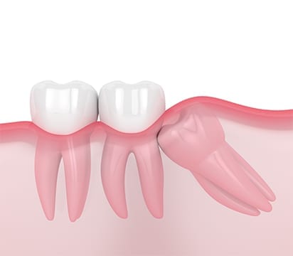 Mesio-angular impacted wisdom tooth