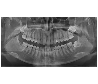 OPG xray