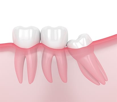 Partially erupted impacted wisdom tooth