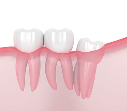 Partially erupted impacted wisdom tooth