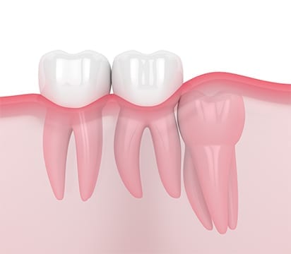 Vertical or upright impacted wisdom tooth
