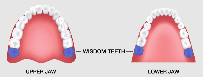 Wisdom Teeth Removal in Gosford, 7 Days: VC Dental