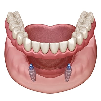 Overdenture
