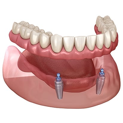 Overdenture