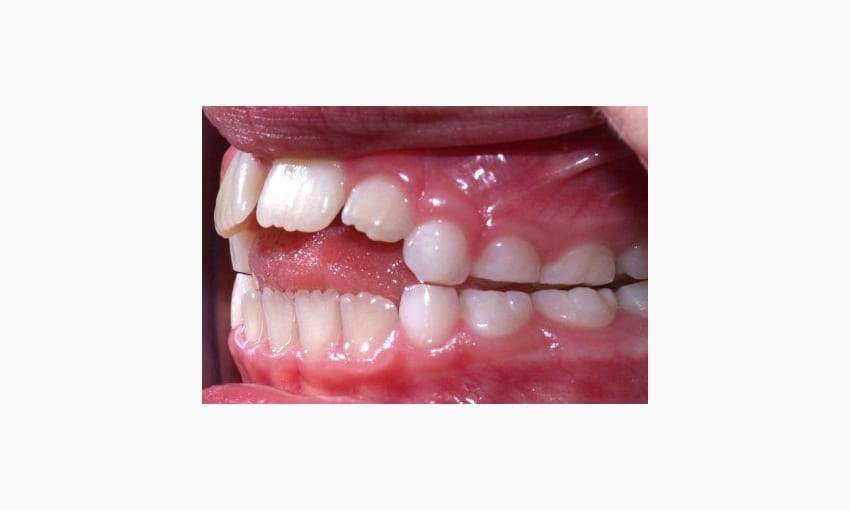 Parafunction: What is it and what are the causes?