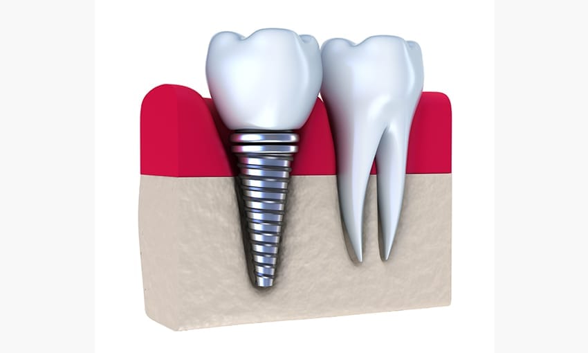 The Benefits of Dental Implants : VC Dental