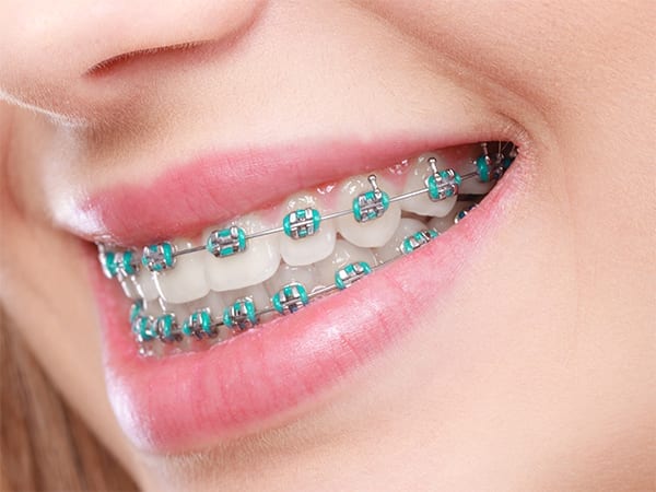 Orthodontic treatment : VC Dental