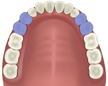 Bicuspids position